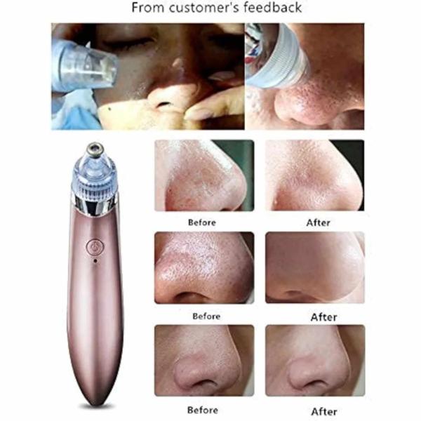 Blackhead Vacuum Negative Pressure 